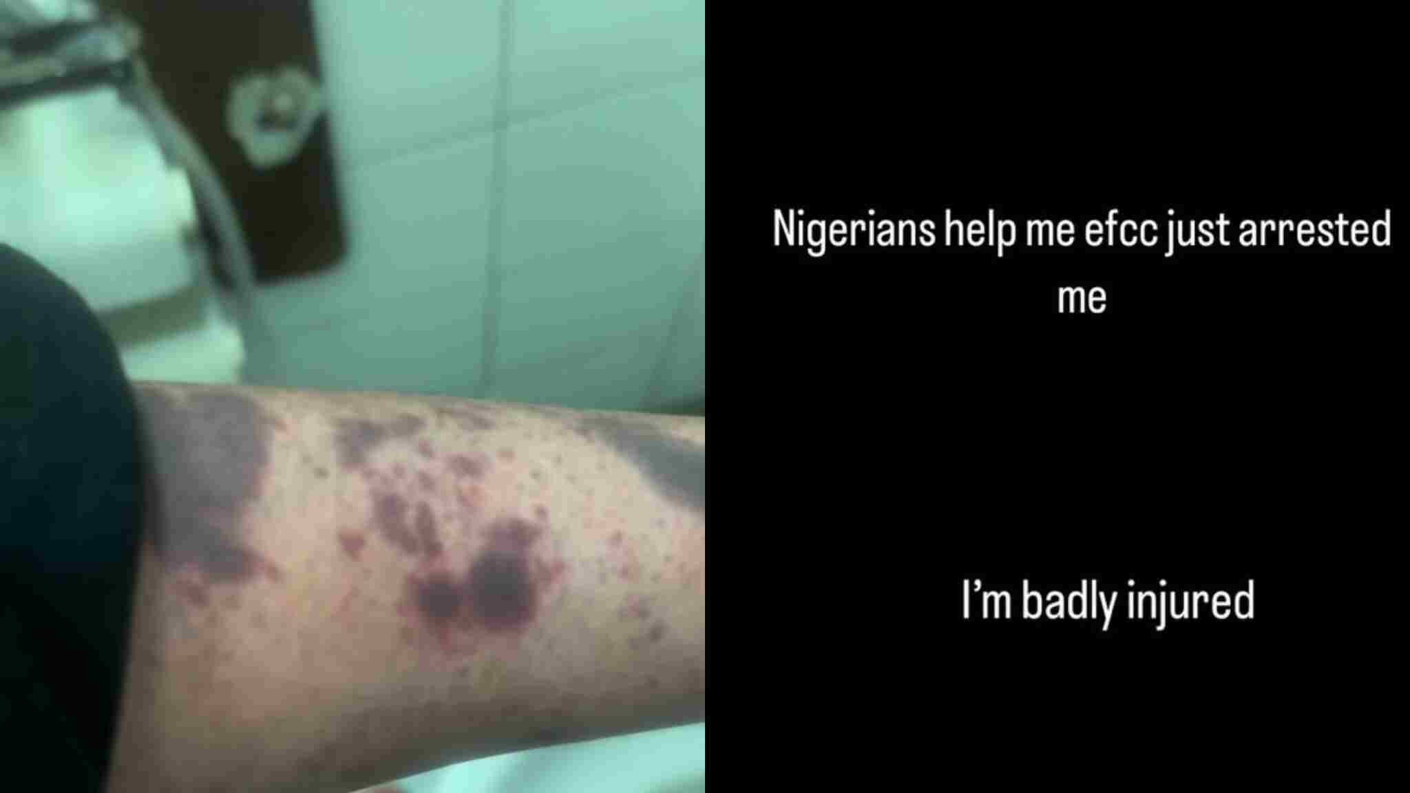 Photo showing bruises on Bobrisky led after he was dragged down from the plane in Lagos on October 31, 2024